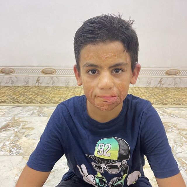 Lieve mensen, Omar en zijn vader zijn inmiddels terug in Irak. De operaties van Omar zijn heel goed gegaan. Hij heeft zelfs een lach op zijn gezicht! Omar en zijn hele familie zijn jullie allemaal erg dankbaar.